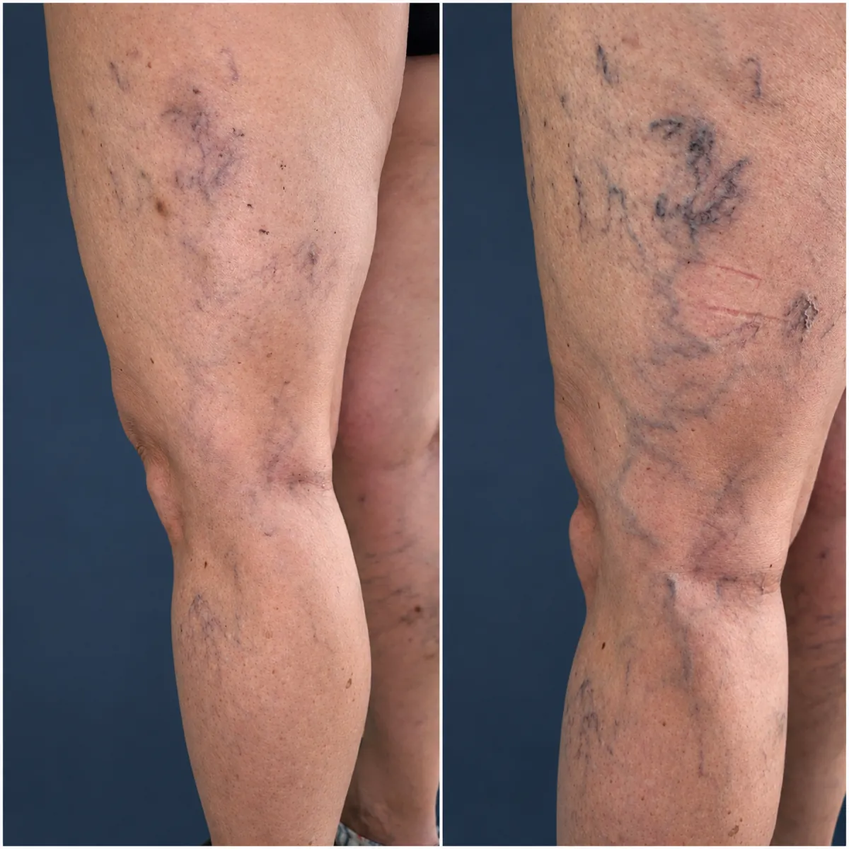 Dos imágenes de piernas con varices visibles en el muslo y detrás de la rodilla